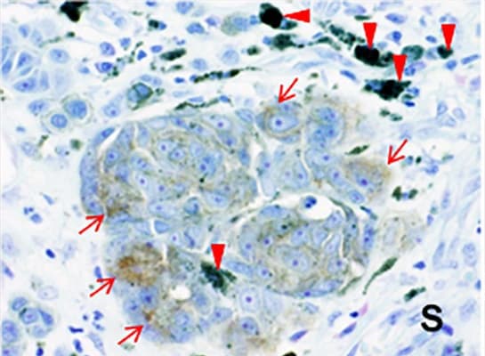 インターロイキン13受容体α2（IL13Rα2）が血管新生を介して悪性黒色腫（メラノーマ）を進展させるメカニズム